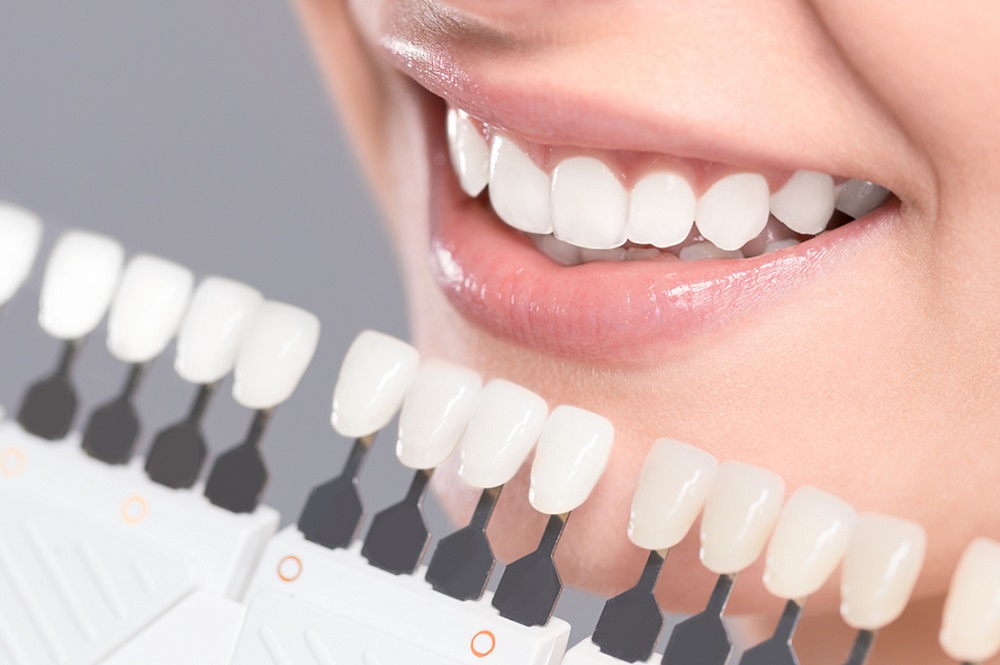 Benefits Of Resin Veneers – Let's Find Out!