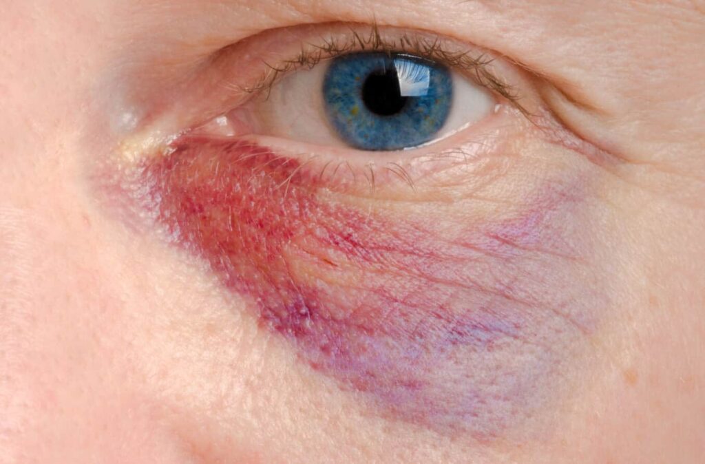 The Incident Of Eye Injury 